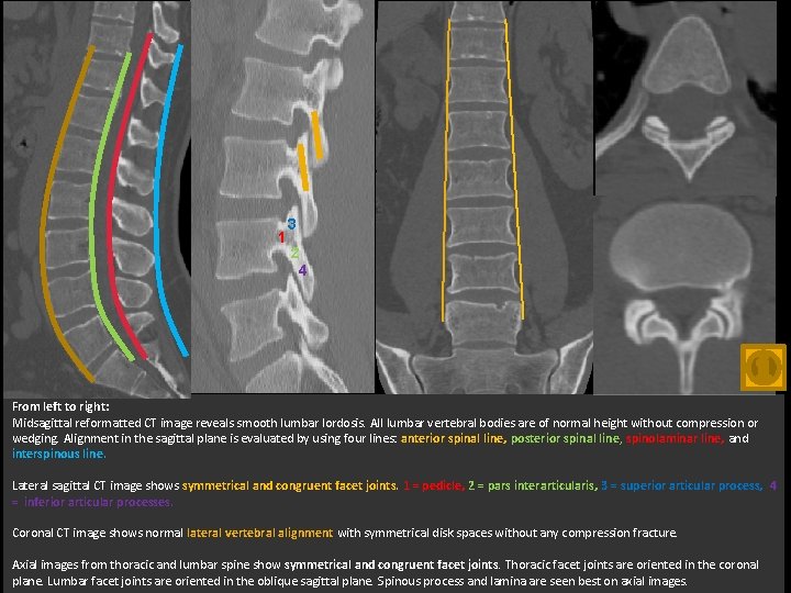 1 3 2 4 From left to right: Midsagittal reformatted CT image reveals smooth