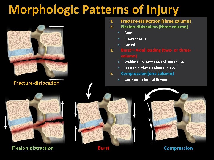 Morphologic Patterns of Injury Fracture-dislocation (three column) Flexion-distraction (three column) 1. 2. Burst—Axial loading