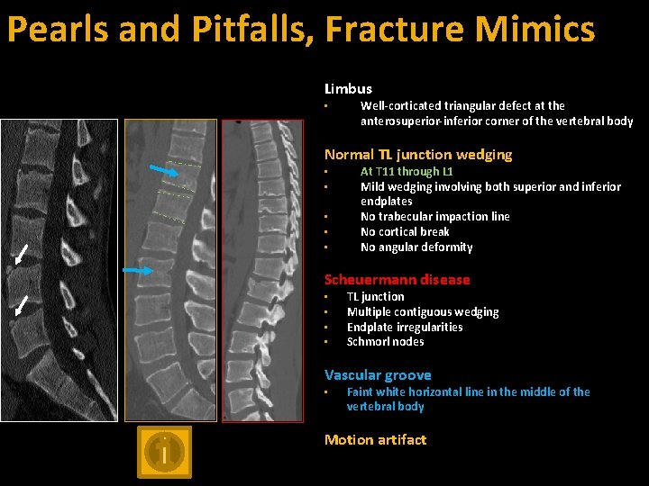 Pearls and Pitfalls, Fracture Mimics Limbus • Well-corticated triangular defect at the anterosuperior-inferior corner