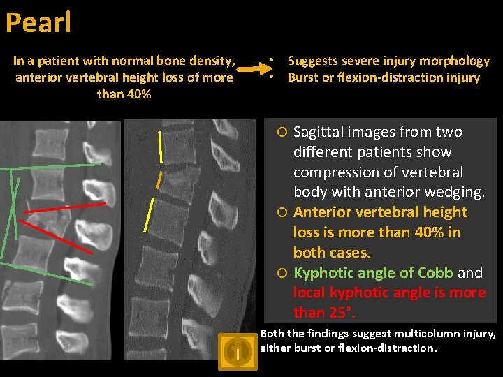 Pearl In a patient with normal bone density, anterior vertebral height loss of more