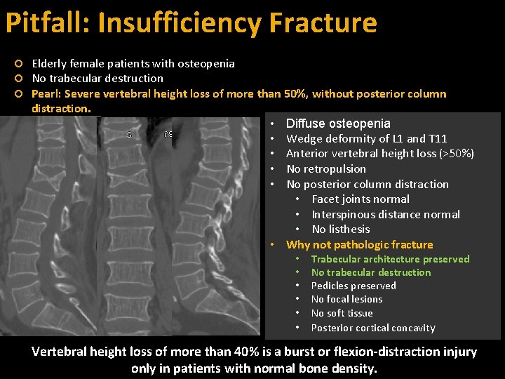 Pitfall: Insufficiency Fracture Elderly female patients with osteopenia No trabecular destruction Pearl: Severe vertebral