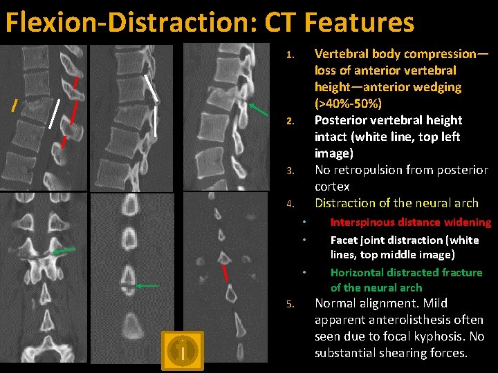 Flexion-Distraction: CT Features Vertebral body compression— loss of anterior vertebral height—anterior wedging (>40%-50%) Posterior