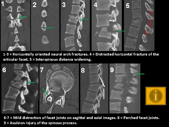 1 2 4 3 5 1 -3 = Horizontally oriented neural arch fractures. 4