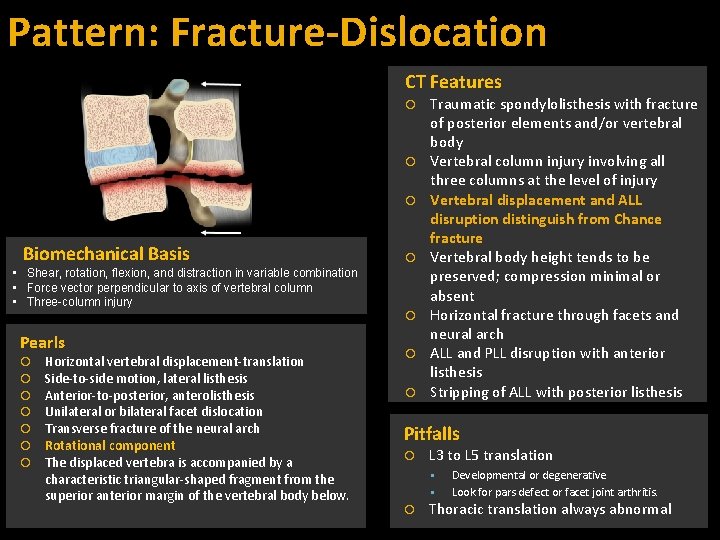 Pattern: Fracture-Dislocation CT Features Biomechanical Basis • Shear, rotation, flexion, and distraction in variable