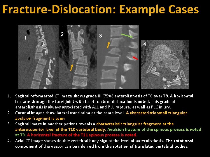 Fracture-Dislocation: Example Cases 1 2 3 4 1. Sagittal reformatted CT image shows grade