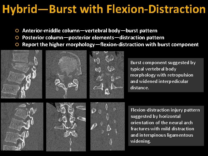 Hybrid—Burst with Flexion-Distraction Anterior-middle column—vertebral body—burst pattern Posterior column—posterior elements—distraction pattern Report the higher