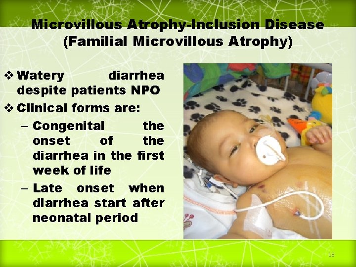 Microvillous Atrophy-Inclusion Disease (Familial Microvillous Atrophy) v Watery diarrhea despite patients NPO v Clinical