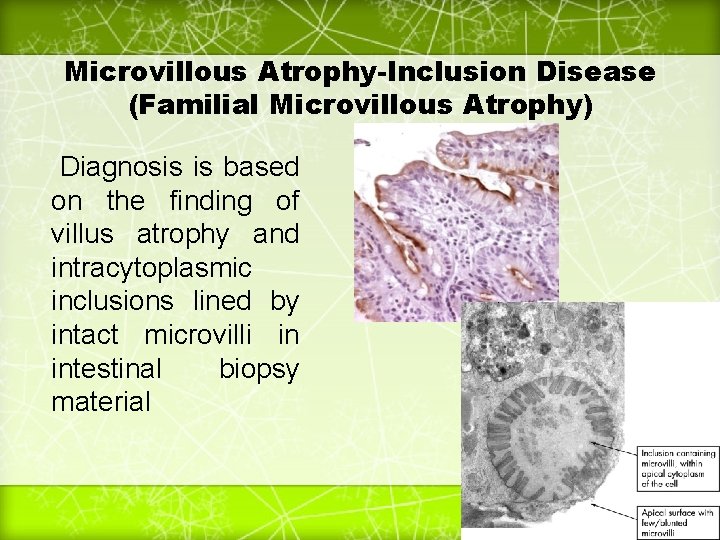 Microvillous Atrophy-Inclusion Disease (Familial Microvillous Atrophy) Diagnosis is based on the finding of villus