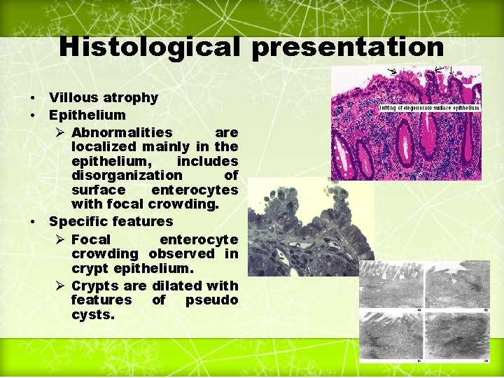 Histological presentation • • • Villous atrophy Epithelium Ø Abnormalities are localized mainly in
