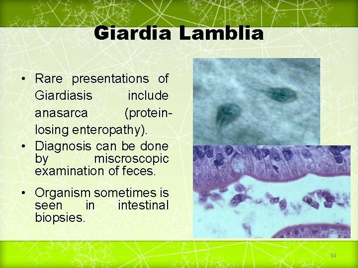 Giardia Lamblia • Rare presentations of Giardiasis include anasarca (proteinlosing enteropathy). • Diagnosis can