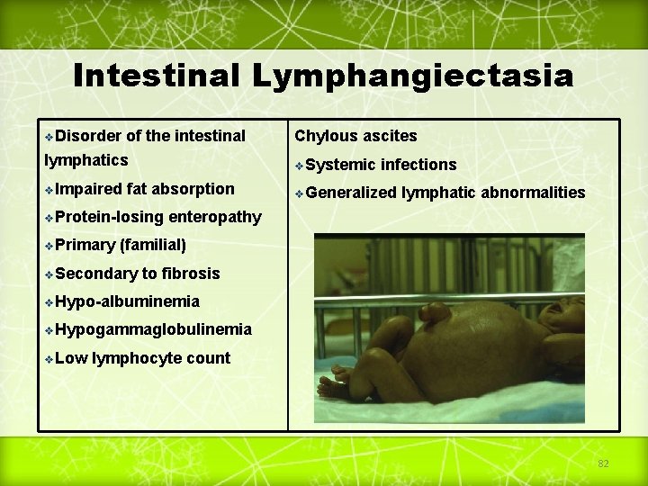 Intestinal Lymphangiectasia v. Disorder of the intestinal Chylous ascites lymphatics v. Systemic v. Impaired