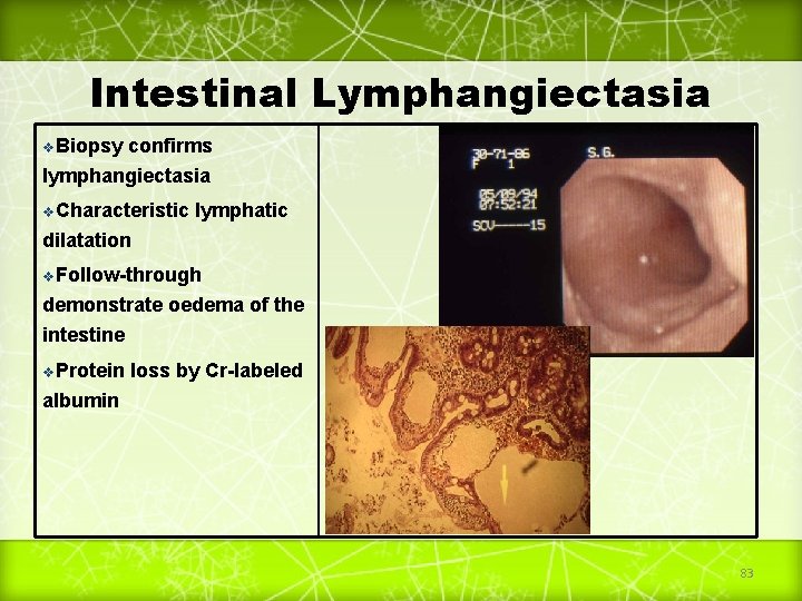 Intestinal Lymphangiectasia v. Biopsy confirms lymphangiectasia v. Characteristic lymphatic dilatation v. Follow-through demonstrate oedema