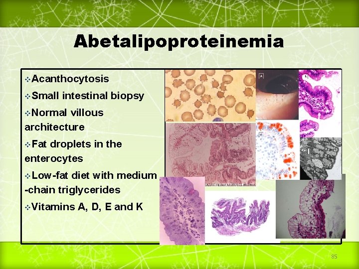 Abetalipoproteinemia v. Acanthocytosis v. Small intestinal biopsy v. Normal villous architecture v. Fat droplets