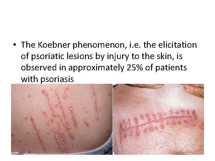  • The Koebner phenomenon, i. e. the elicitation of psoriatic lesions by injury