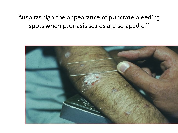 Auspitzs sign: the appearance of punctate bleeding spots when psoriasis scales are scraped off