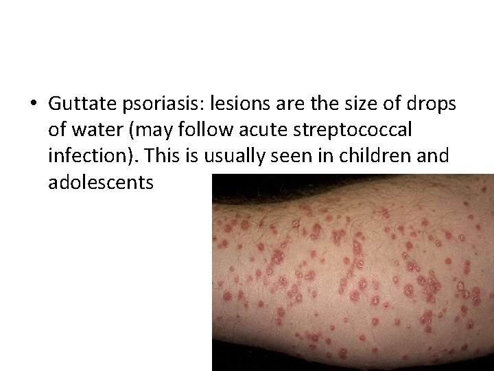  • Guttate psoriasis: lesions are the size of drops of water (may follow