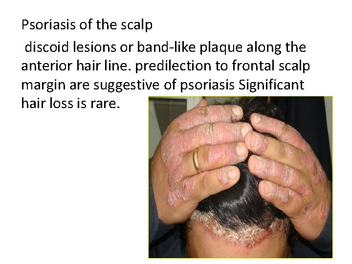 Psoriasis of the scalp discoid lesions or band-like plaque along the anterior hair line.