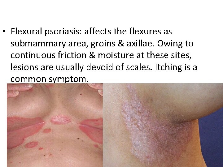  • Flexural psoriasis: affects the flexures as submammary area, groins & axillae. Owing