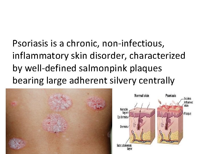 Psoriasis is a chronic, non-infectious, inflammatory skin disorder, characterized by well-defined salmonpink plaques bearing