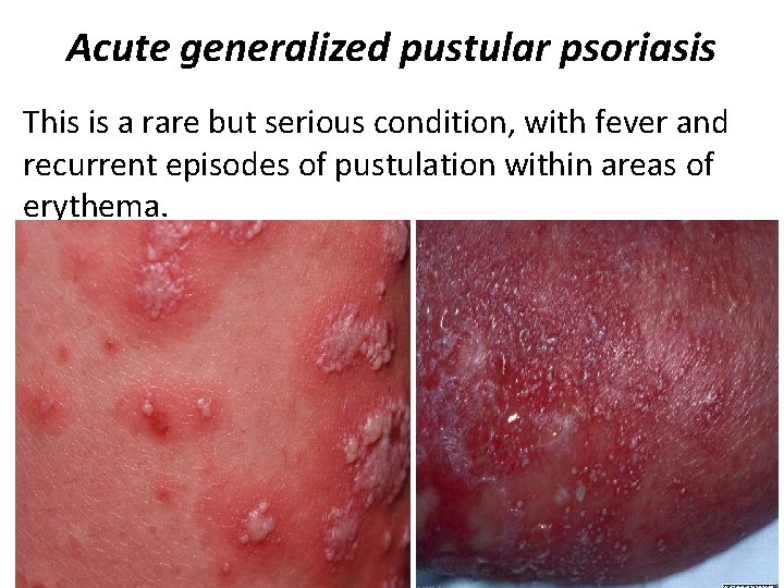 Acute generalized pustular psoriasis This is a rare but serious condition, with fever and