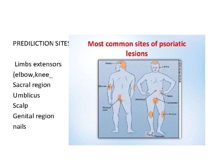 PREDILICTION SITES Limbs extensors (elbow, knee_ Sacral region Umblicus Scalp Genital region nails 