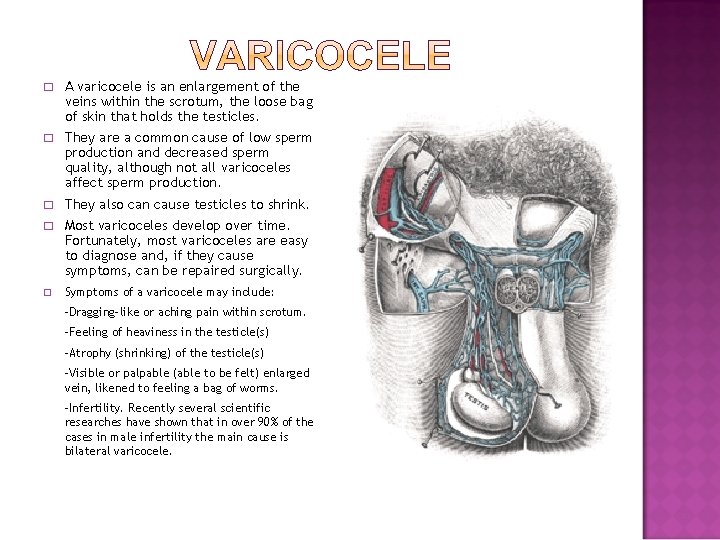 � A varicocele is an enlargement of the veins within the scrotum, the loose