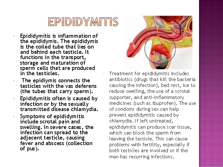  Epididymitis is inflammation of the epididymis. The epididymis is the coiled tube that