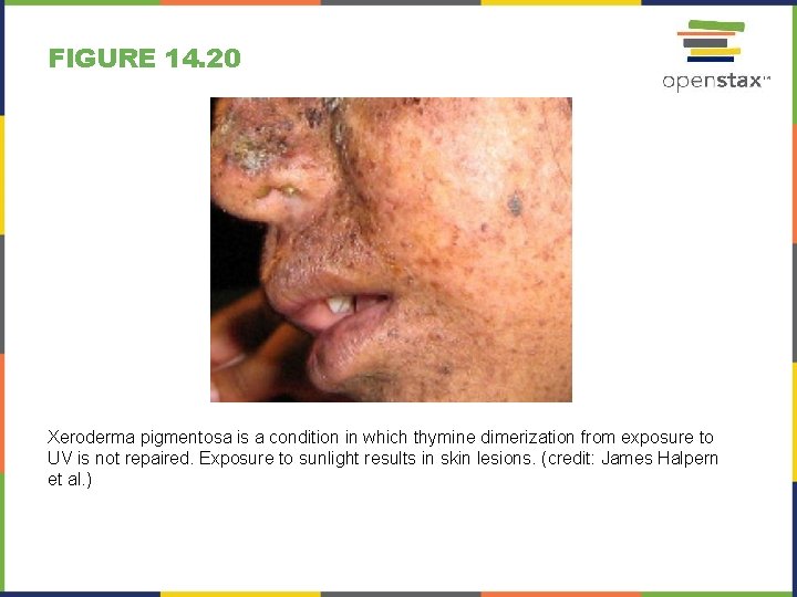 FIGURE 14. 20 Xeroderma pigmentosa is a condition in which thymine dimerization from exposure