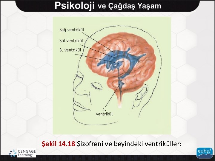 Şekil 14. 18 Şizofreni ve beyindeki ventriküller: 