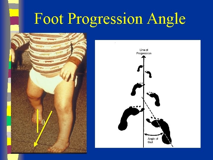 Foot Progression Angle 