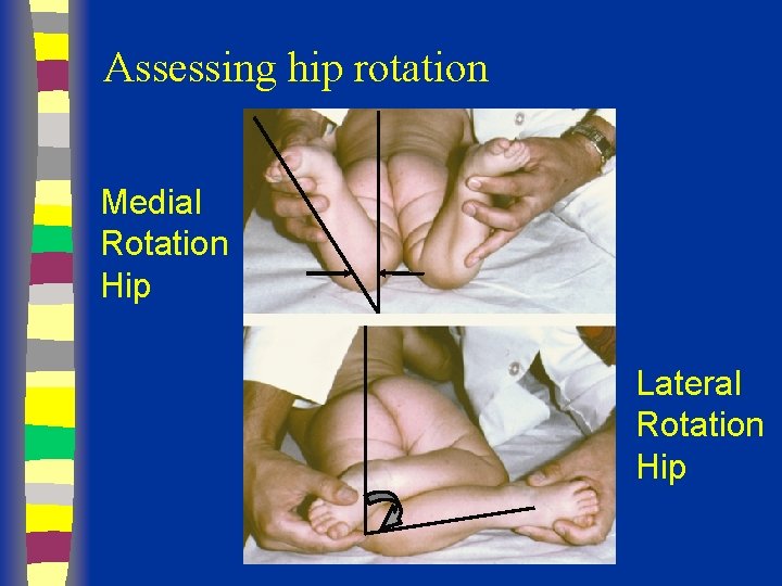 Assessing hip rotation Medial Rotation Hip Lateral Rotation Hip 