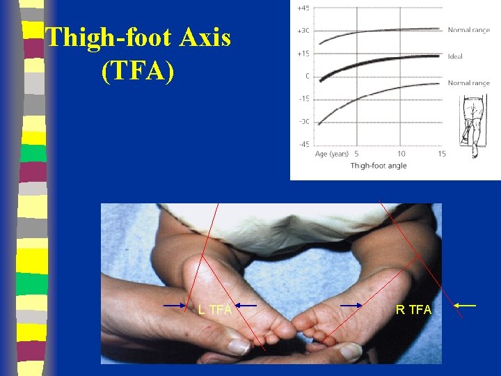 Thigh-foot Axis (TFA) L TFA R TFA 