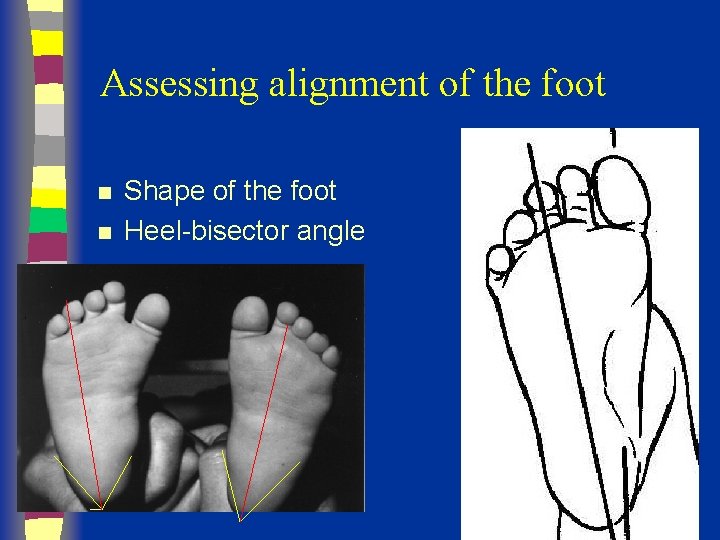 Assessing alignment of the foot n n Shape of the foot Heel-bisector angle 