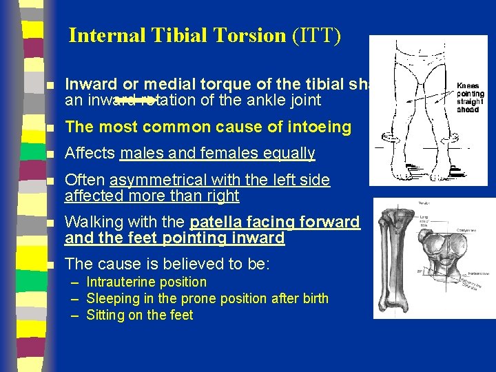 Internal Tibial Torsion (ITT) n Inward or medial torque of the tibial shaft an