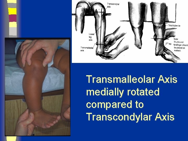 Transmalleolar Axis medially rotated compared to Transcondylar Axis 