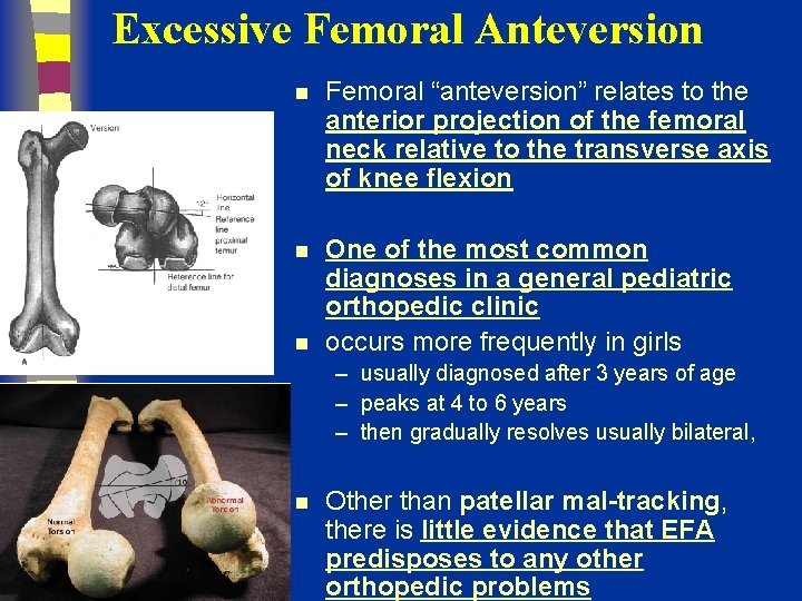 Excessive Femoral Anteversion n Femoral “anteversion” relates to the anterior projection of the femoral