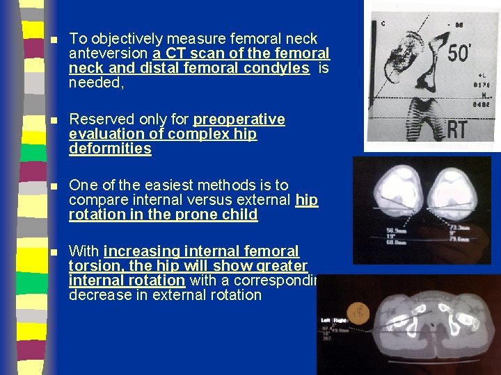 n To objectively measure femoral neck anteversion a CT scan of the femoral neck