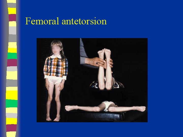 Femoral antetorsion 