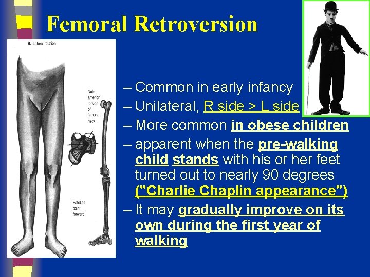 Femoral Retroversion – Common in early infancy – Unilateral, R side > L side