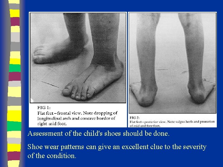 Assessment of the child's shoes should be done. Shoe wear patterns can give an