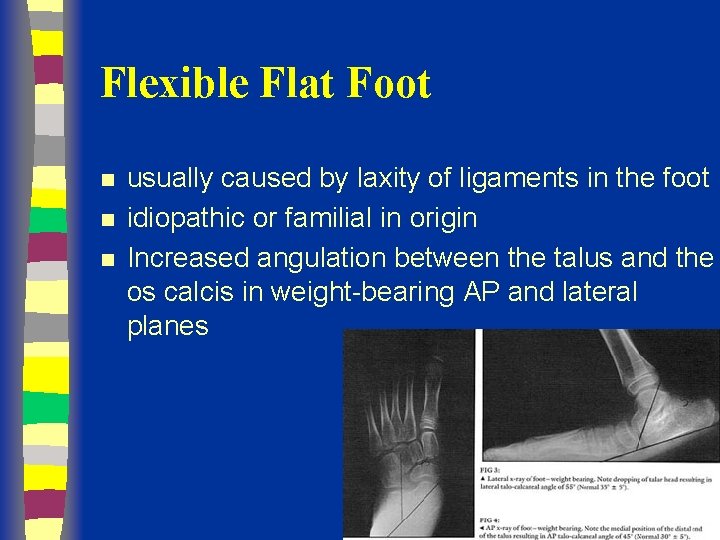 Flexible Flat Foot n n n usually caused by laxity of ligaments in the