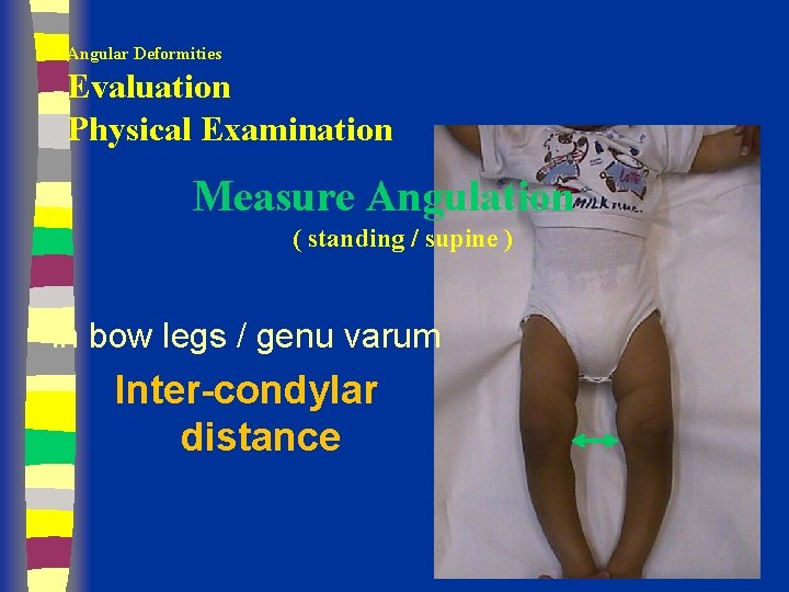Angular Deformities Evaluation Physical Examination Measure Angulation ( standing / supine ) in bow