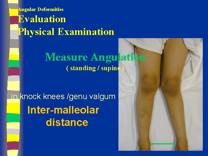 Angular Deformities Evaluation Physical Examination Measure Angulation ( standing / supine ) in knock