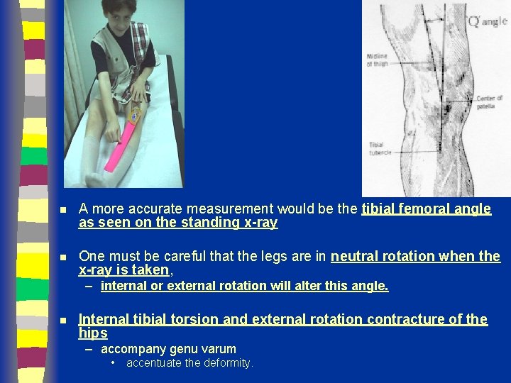 n A more accurate measurement would be the tibial femoral angle as seen on