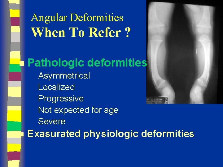 Angular Deformities When To Refer ? n Pathologic deformities Asymmetrical Localized Progressive Not expected