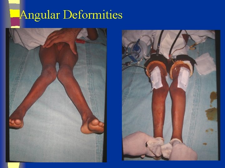 Angular Deformities 