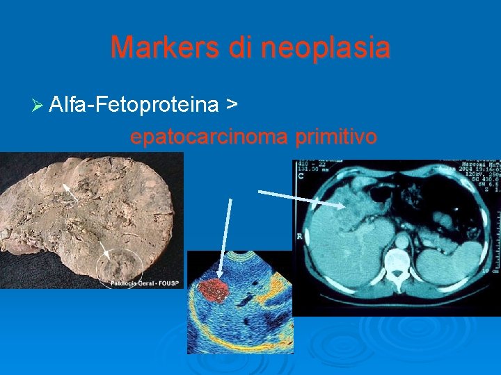 Markers di neoplasia Ø Alfa-Fetoproteina > epatocarcinoma primitivo 