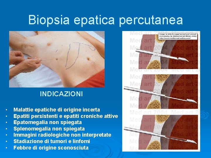 Biopsia epatica percutanea INDICAZIONI • • Malattie epatiche di origine incerta Epatiti persistenti e