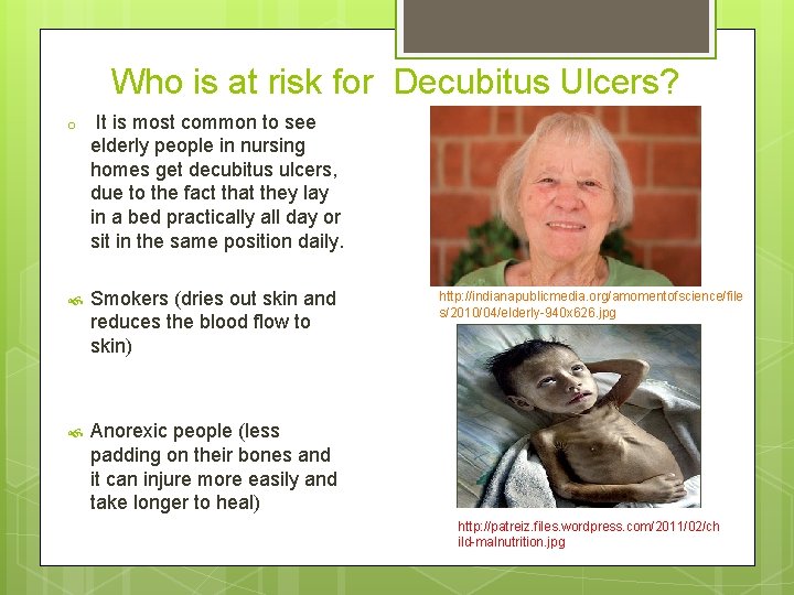 The Truth about Decubitus Ulcers Created By Kelsey