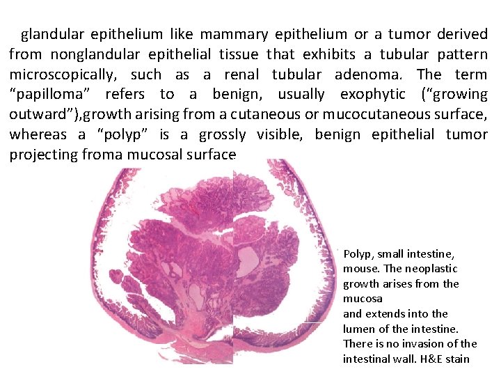 glandular epithelium like mammary epithelium or a tumor derived from nonglandular epithelial tissue that